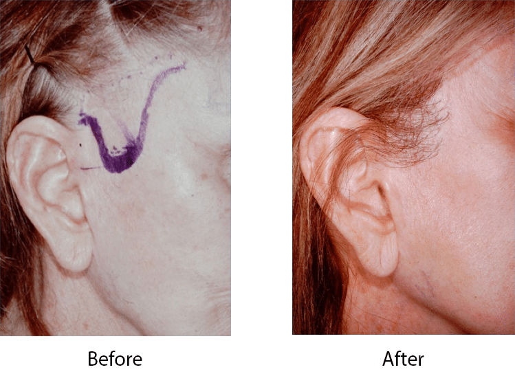 Hair loss from bad facelift