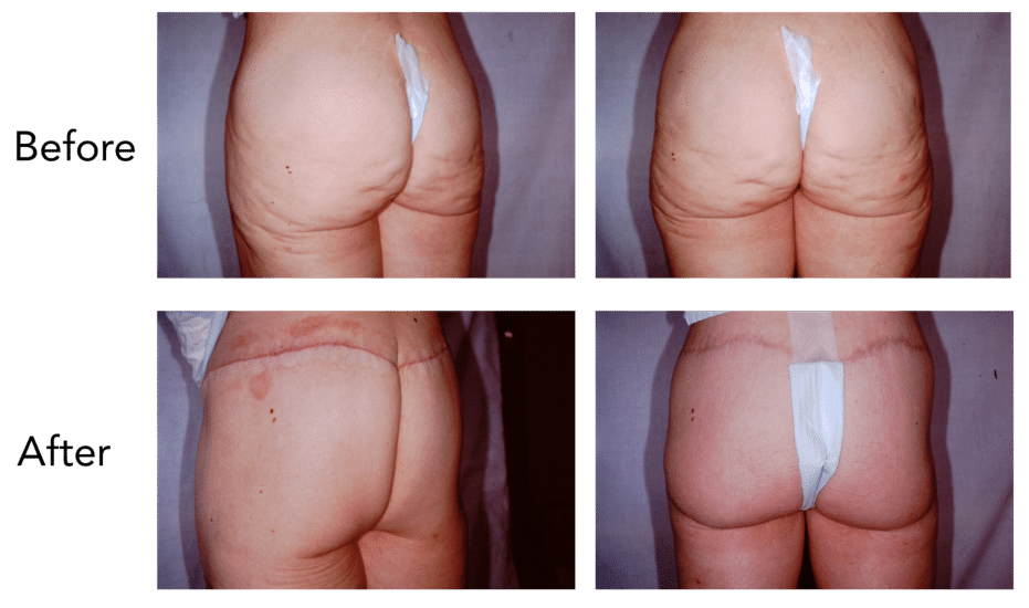 Buttock and Thigh Lift Before and After