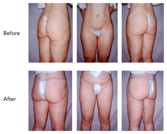 Buttock and Thigh Lift Before and After