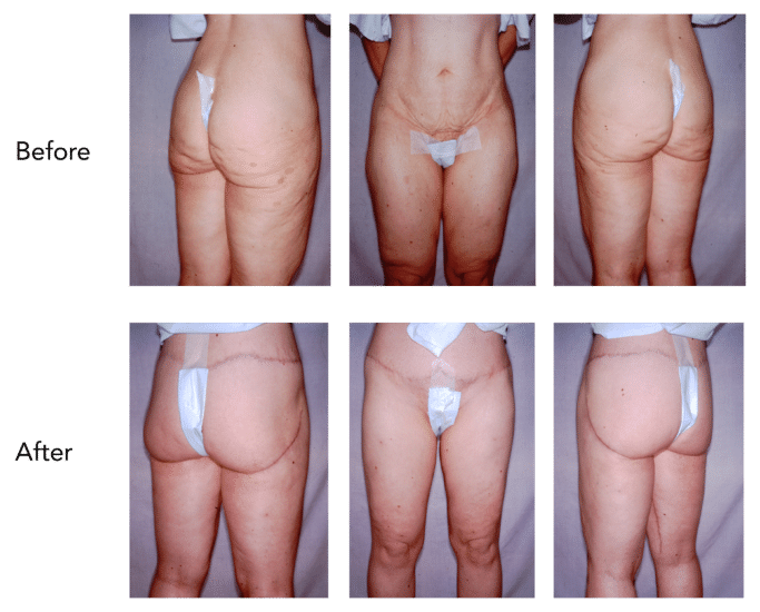 Buttock and Thigh Lift Before and After