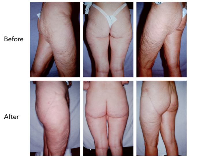 Buttock and Thigh Lift Before and After
