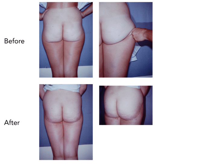 Buttock and Thigh Lift Before and After