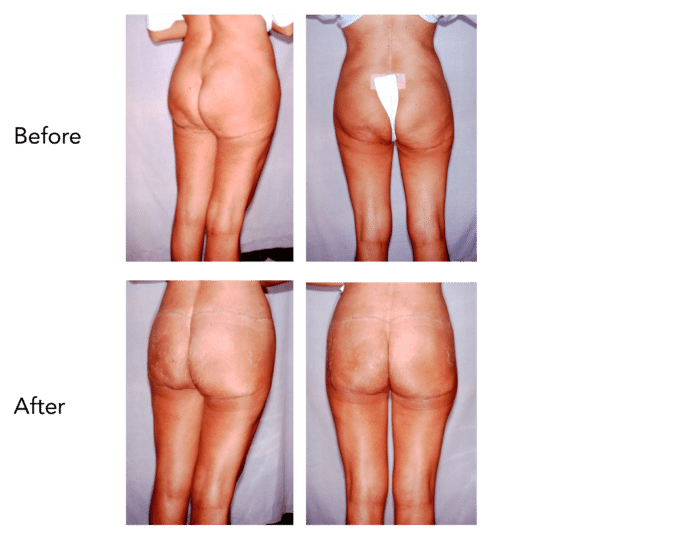 Buttock and Thigh Lift Before and After