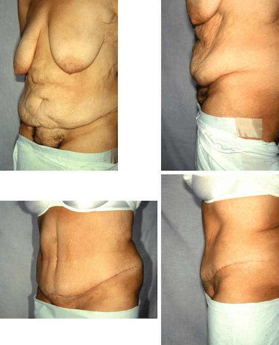 Before and after pictures of a Panniculectomy