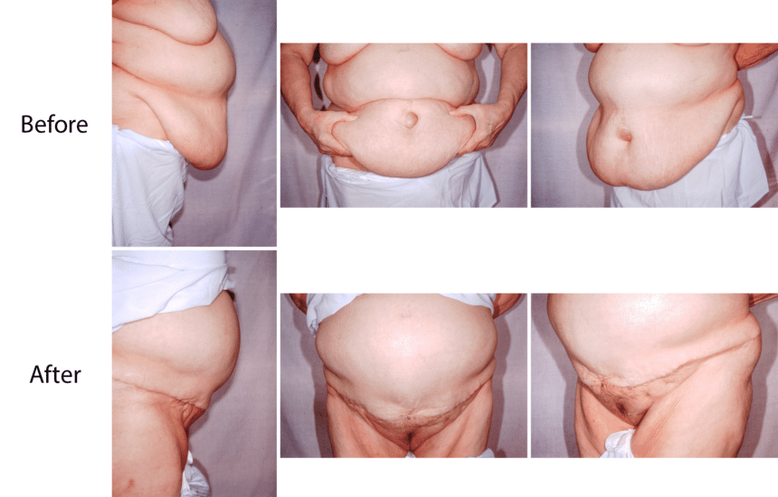 Panniculectomy photos before and after